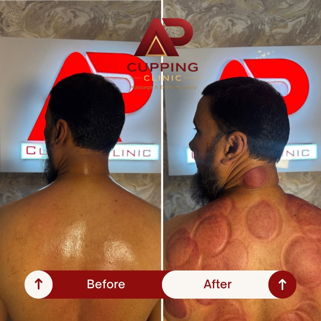 Before and after upper back treatment example