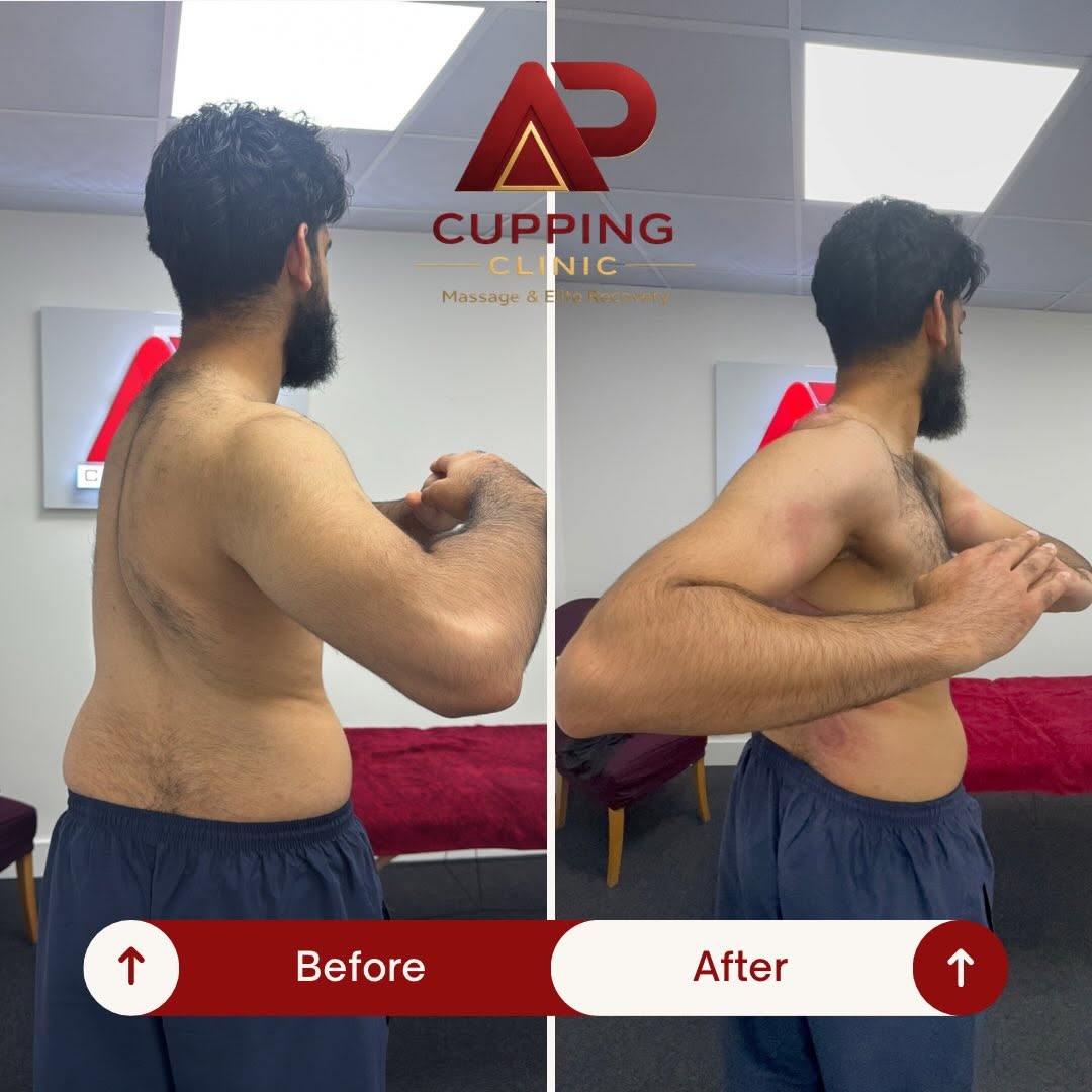 Before and after shoulder rotation example