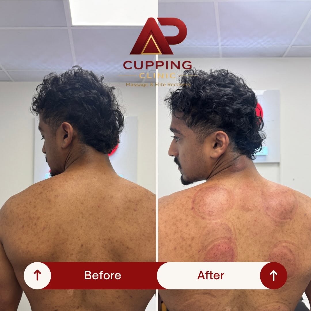 Before and after upper back treatment example